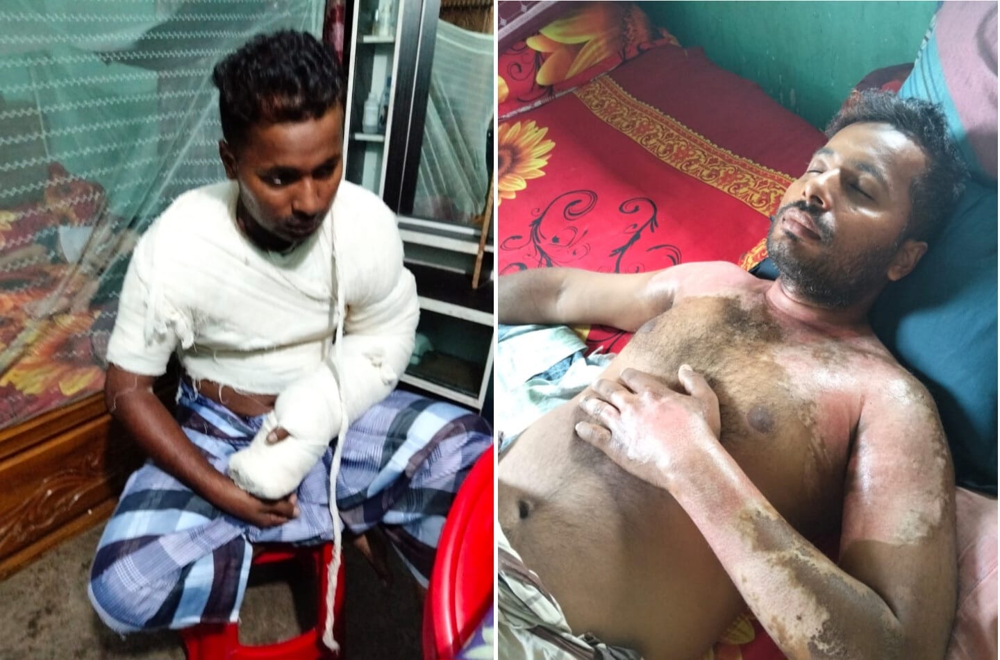 বিদ্যুৎস্পৃষ্ট হয়ে দগ্ধ লাইনম্যান নূর আলম, চিকিৎসার মধ্যেই বদলি নিয়ে বিপাকে